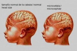 Governo cria grupo de trabalho para combate a surto de microcefalia